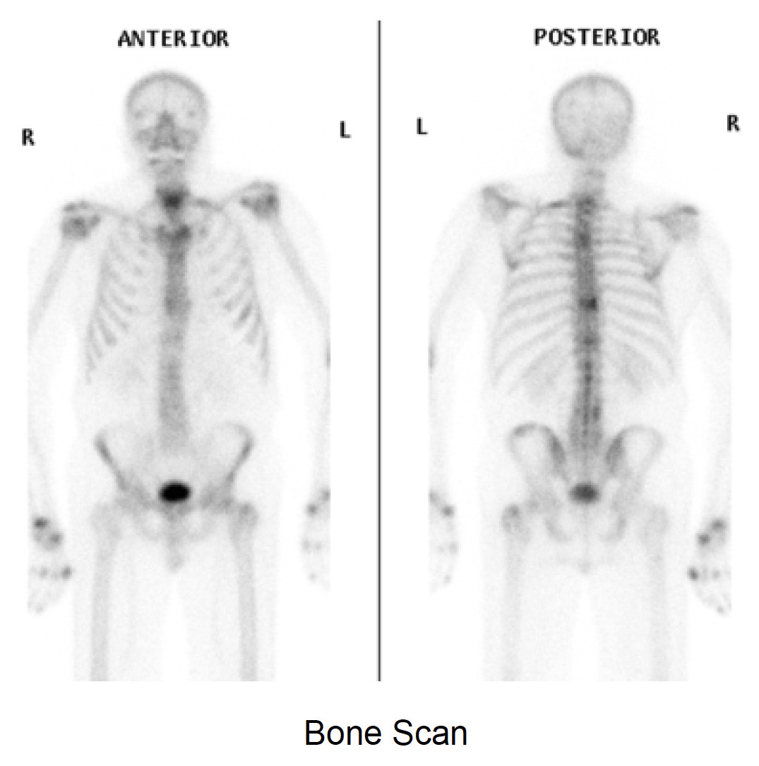 Bone Scan image